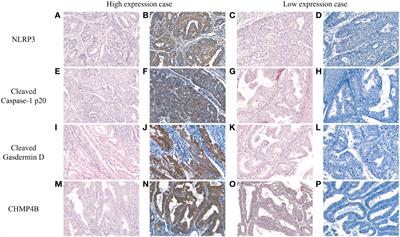 Prognostic significance of pyroptosis-associated molecules in endometrial cancer: a comprehensive immunohistochemical analysis